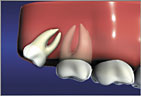 Wisdom Teeth Distal Impaction